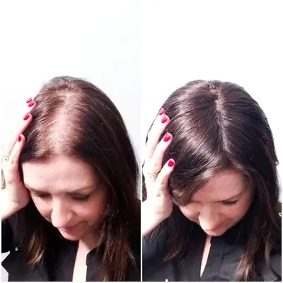 Trichologist | Hair loss | Hair Analysis